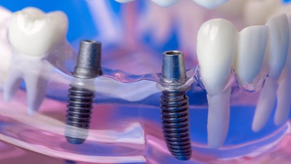 Implantati so zobni vsadki za čudovit nasmeh
