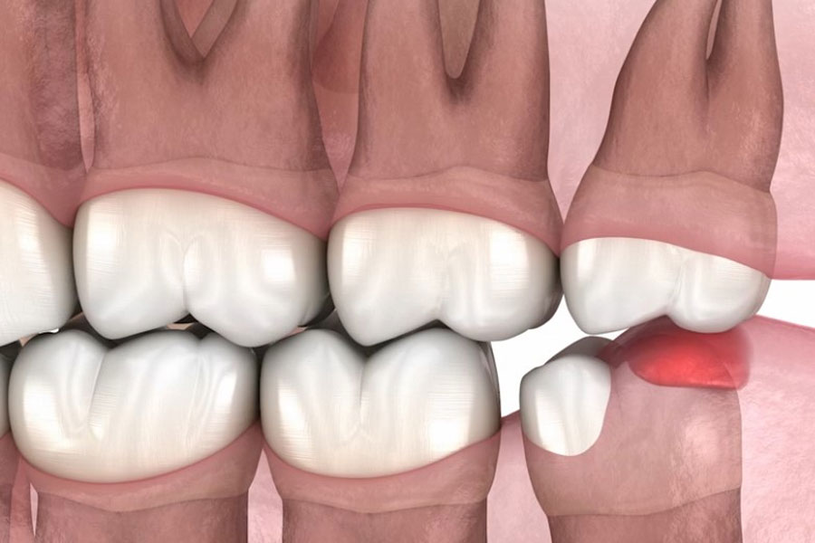 zobna kirurgija Lux dental